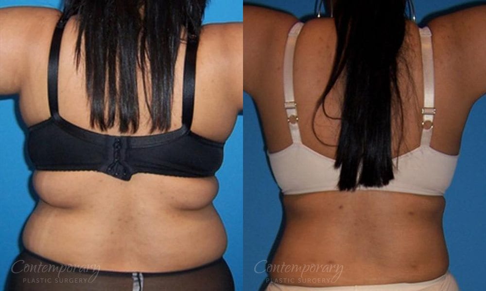 Back Liposuction: Back Fat Removal