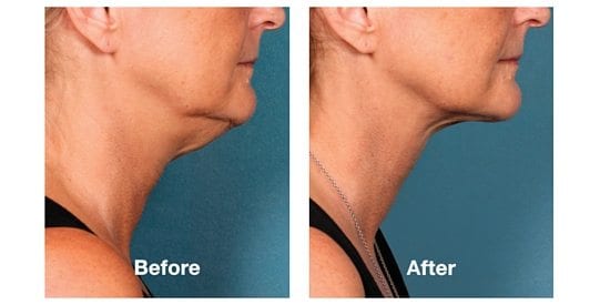 Kybella Before and After